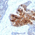 FFPE human ovarian carcinoma sections stained with 100 ul anti-TAG-72 / CA72.4 (clone B72.3 + CA72/733) at 1:100. HIER epitope retrieval prior to staining was performed in 10mM Citrate, pH 6.0.